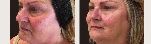 K-Luxe before and after — clinical example