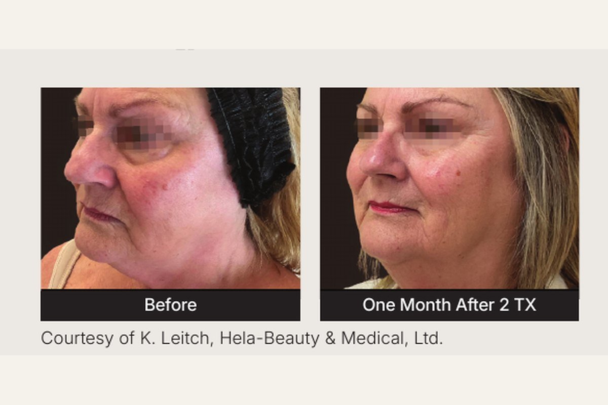 Ultra / K-Luxe before and after — radiant skin brightening