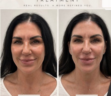 Satori Instagram Xerf before and after
