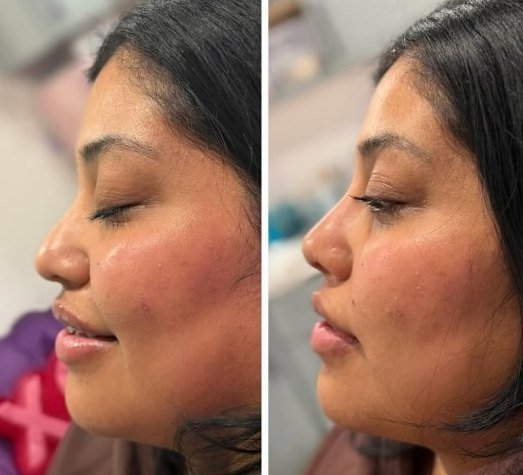 Before and after — facial balancing, Satori patient